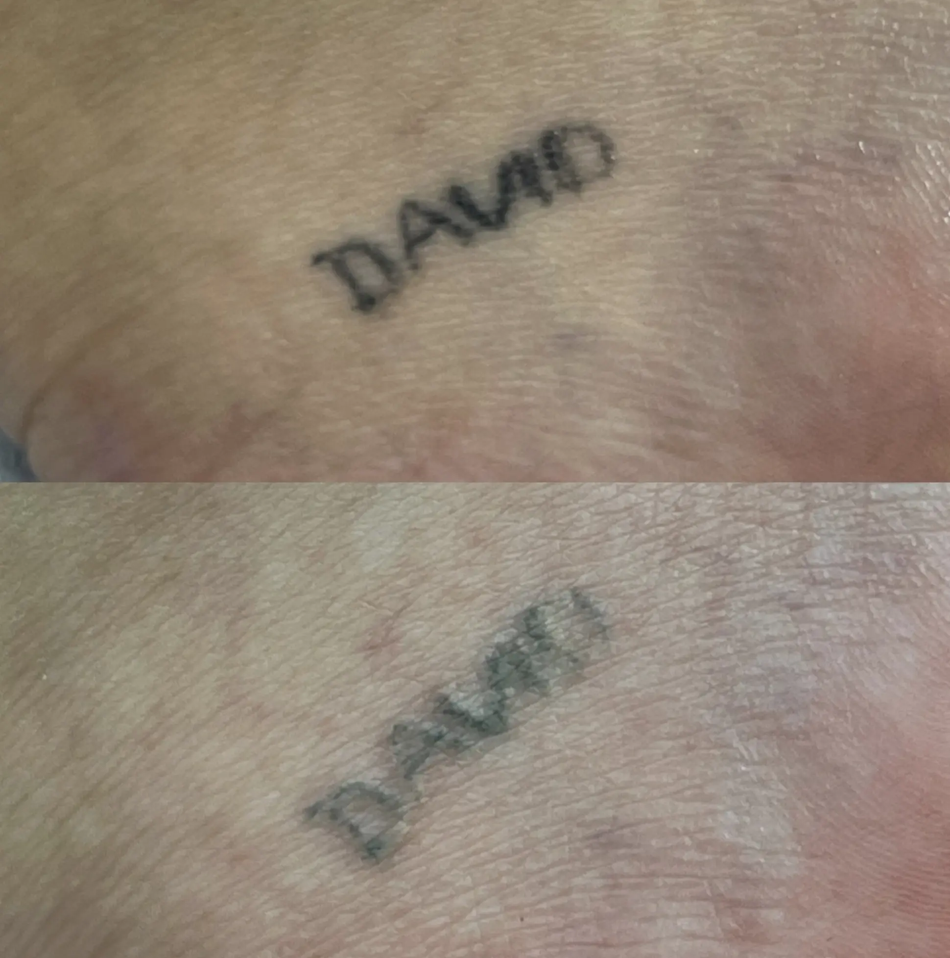 does tattoo removal affect hair growth