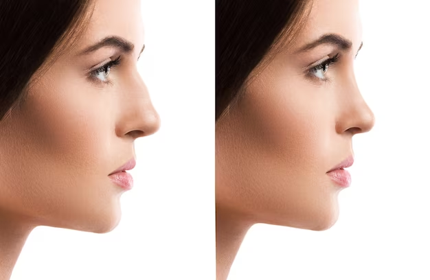 Non-surgical nostril reduction: before and after photos showcasing the effectiveness of the procedure