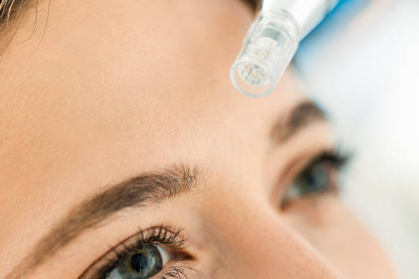 After micro-needling therapy: when can fillers be done? - expert advice