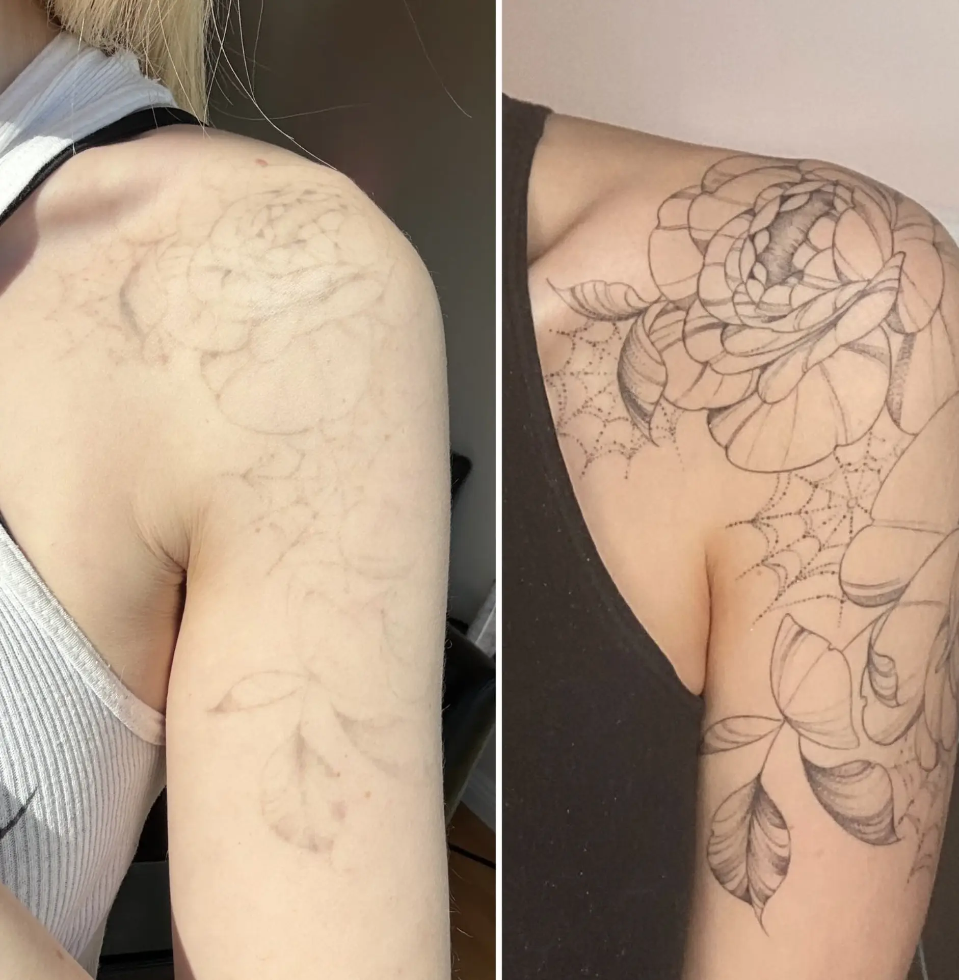 laser hair removal on tattoos danger