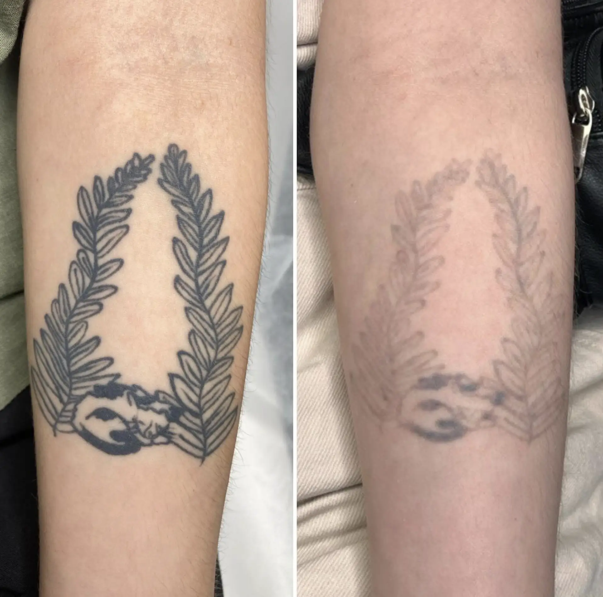 laser tattoo removal Brisbane